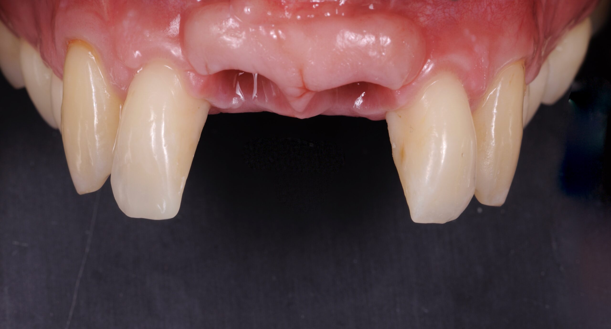fotka zubů implantologie