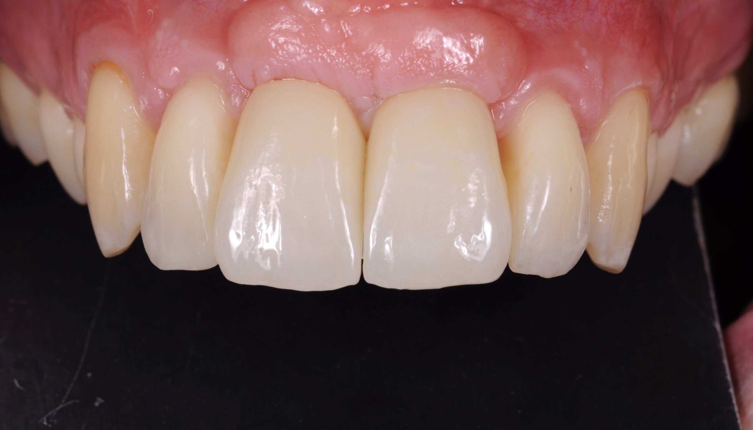 fotka nových zubů implantologie