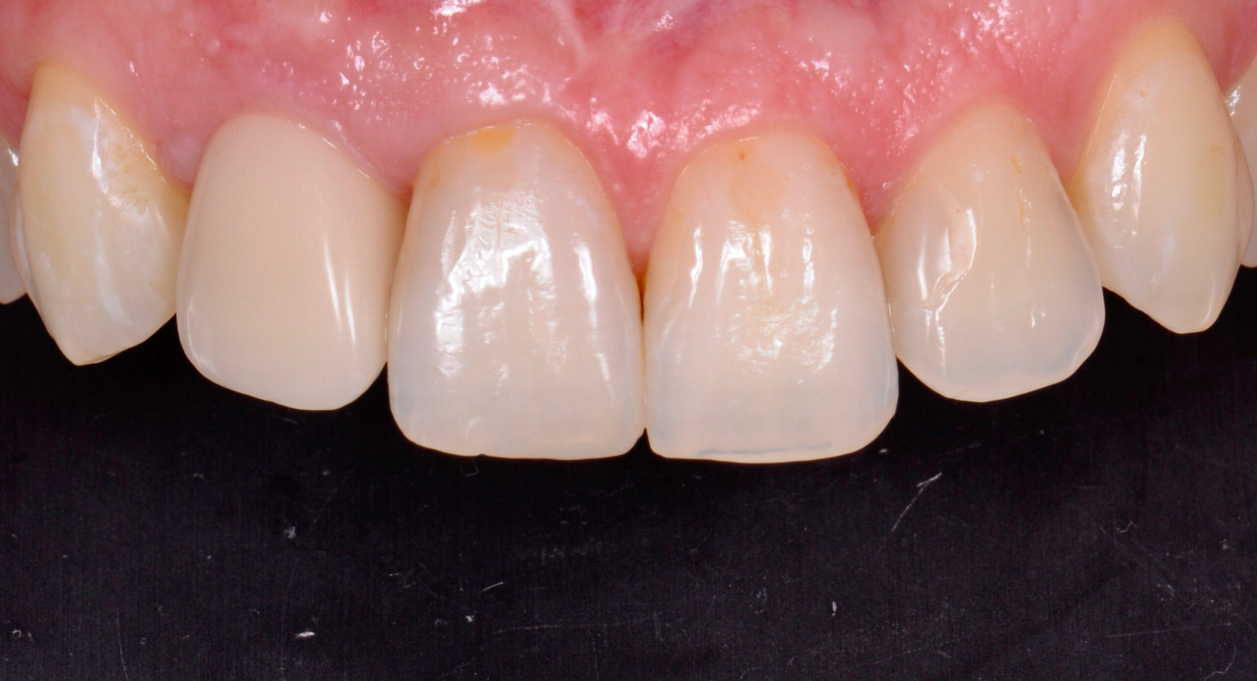 fotka nových zubů implantologie
