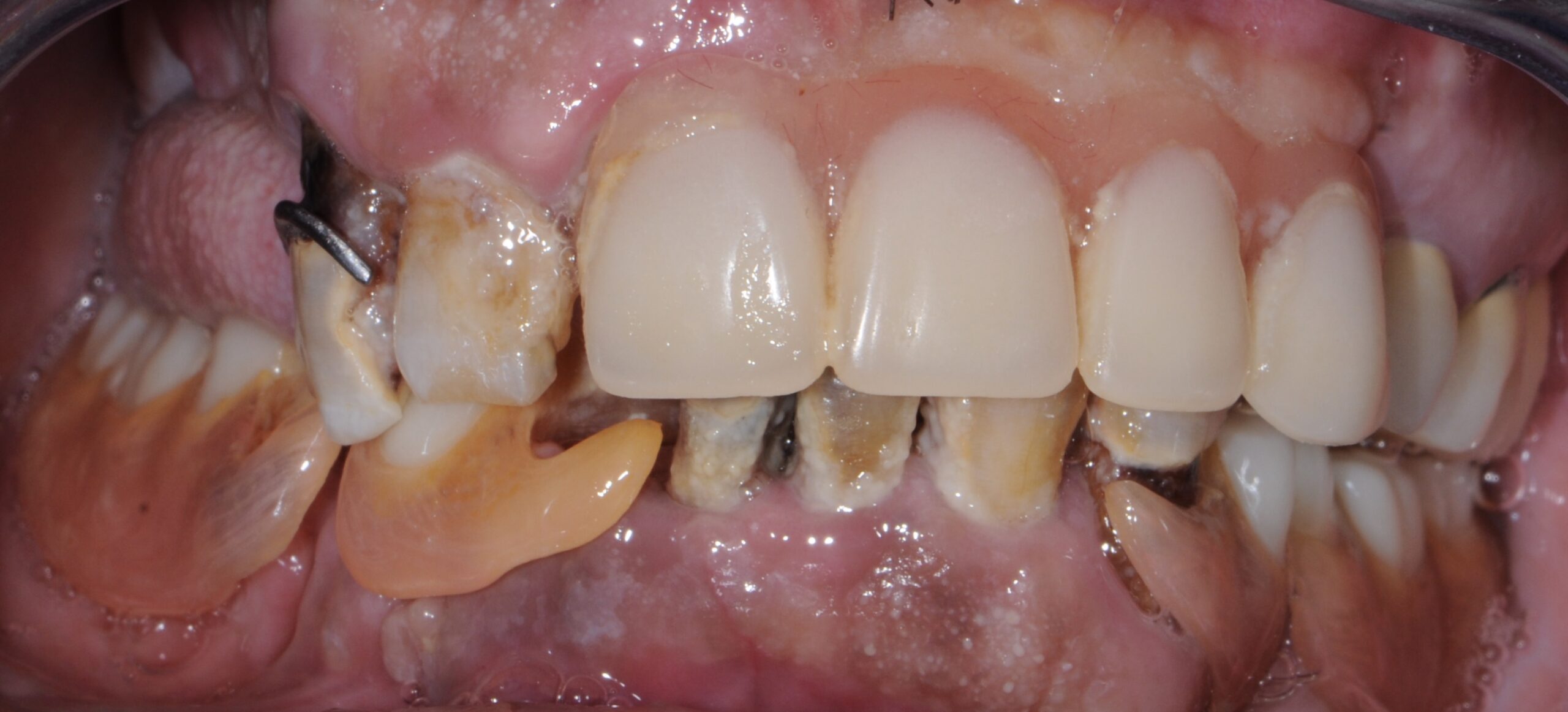 fotka zubů implantologie